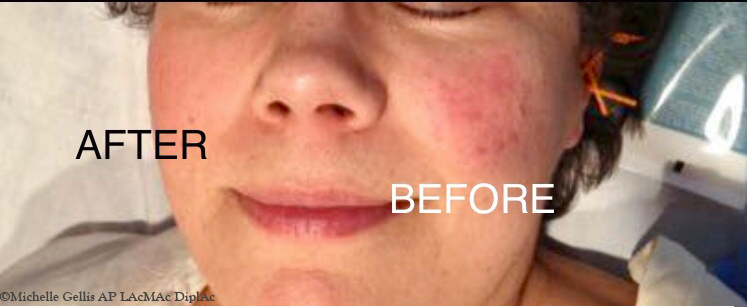 before and after facial cupping treatment